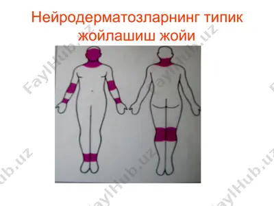 нейродерматозларнинг типик жойлашиш жойи — PPT