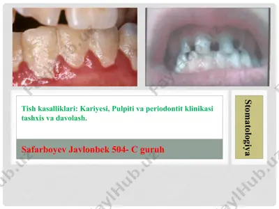 tish kasalliklari: kariyesi, pulpiti va periodontit klinikasi tashxis va davolash — PPTX