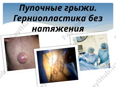 пупочные грыжи. герниопластика без натяжения — PPTX