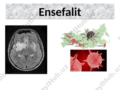 ensefalit — PPTX