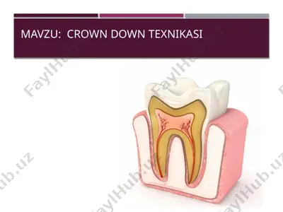 crown down texnikasi — PPTX
