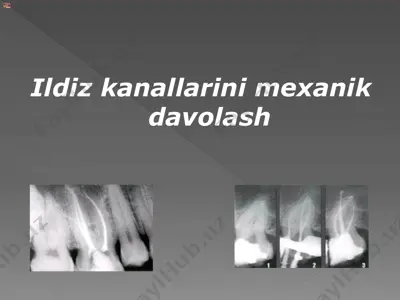 endodontik davolash standarti — PPTX