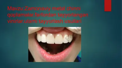 zamonaviy metal chinni qoplamalar, farfordan tayyorlangan vinirlar, ularni tayyorlash usullari — PPTX