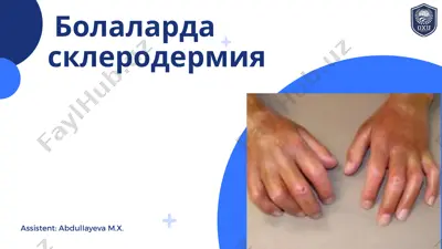 ювенил склеродермия — PDF