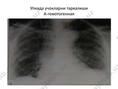 туберкулезни таркалувчи а-гемотогенная — PDF