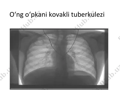 o‘ng o‘pkani kovakli tuberkulezi — PDF