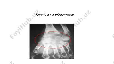 suyaq-bug‘im tuberkulezi — PDF
