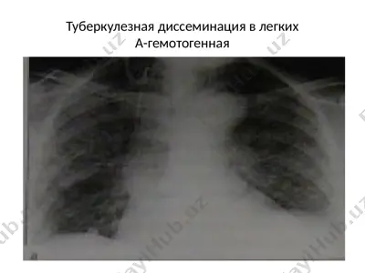 tuberkulezni disseminatsiya etish (legkalar) — PPTX