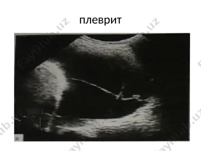 плеврит — PPTX