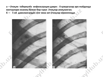 tuberkulez infiltrlatsiya davri — PPTX