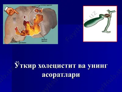 ўткир холецистит ваунингасоратлари — PPT