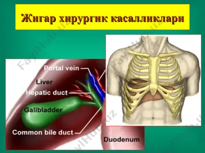жигар хирургик касалликлари — PPT