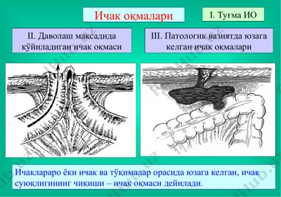 ичак оқмалари — PPT