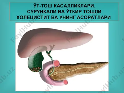 ўт-тошкасалликлари. сурункали ваўткир тошли холецистит ва унинг асоратлари — PPT
