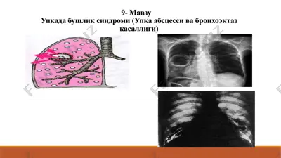 упкадабушлик синдроми (упкаабсцессивабронхоэктазкасаллиги) — PPTX