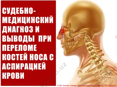 sudebno-meditsinskiy diagnos i vyvody pri perelome kostey nosa s aspiratsiey krovi — PPTX