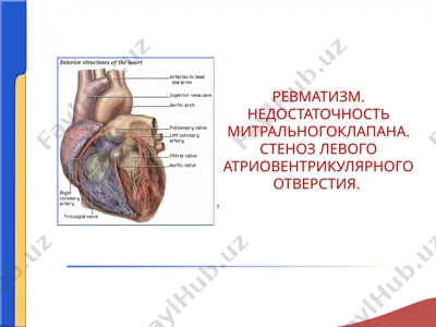 ревматизм. недостаточность митральногоклапана. стеноз левого атриовентрикулярного отверстия. — PPTX