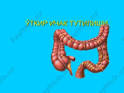 utkir ichak tutilishi — PPT