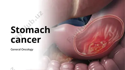 stomach cancer — PPTX