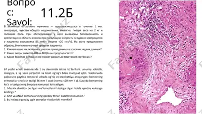 gigantskaya kletochnaya arteriit — PPTX