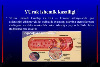 yurak ishemik kasalligi — PPT