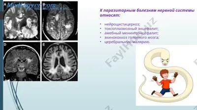 parazitarnie bolezni nervnoy sistemi — PPT