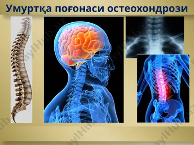 umurtqa pog'onasi osteoxondrozi — PPTX