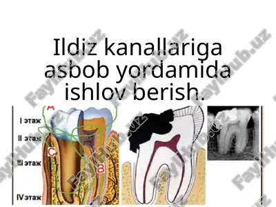 ildiz kanallariga asbob yordamida ishlov berish — PPTX
