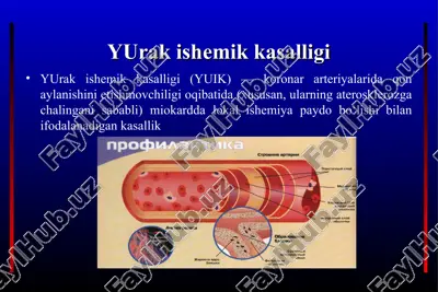 yurak ishemik kasalligi — PPT