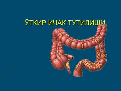 o'tkir ichak tutilishi — PPT
