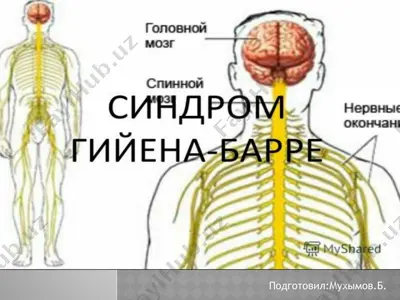 sindrom giyena-barre — PPT