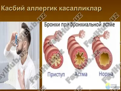 kasbiy allergik kasalliklar — PPT