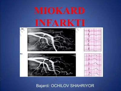 miokard infarkti — PPT