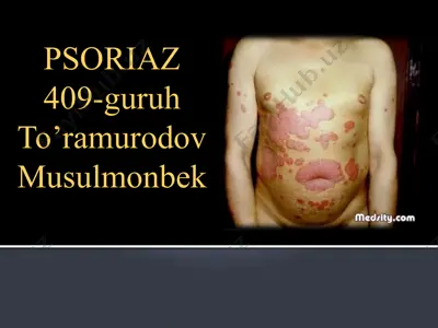 psoriaz — PPTX