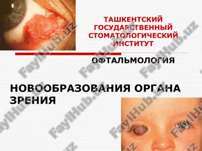 opuxoli organa zreniya — PPT