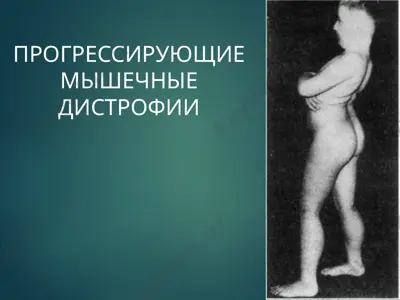 progressiruyushie mishechnie distrofii — PPTX