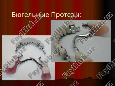byugelnie protezi — PPTX