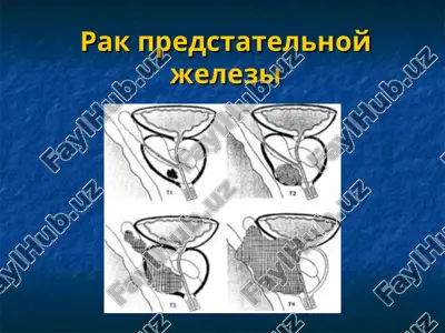 rak predstatelnoy jelezi — PPT