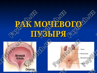 rak mochevogo puzirya — PPT