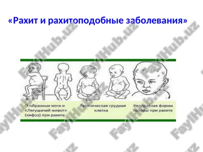 raxit i raxitopodobnie zabolevaniya — PPT