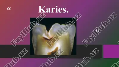 karies — PPTX