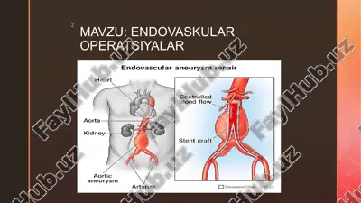 endovaskular operatsiyalar — PPTX