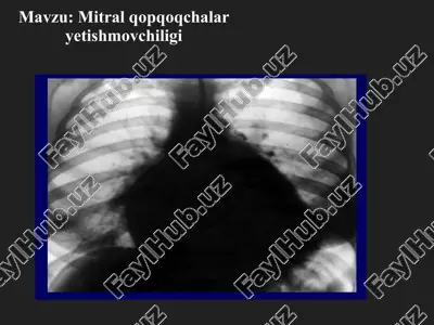 mitral qopqoqchalar yetishmovchiligi — PPTX
