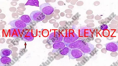 o’tkir leykoz — PPTX