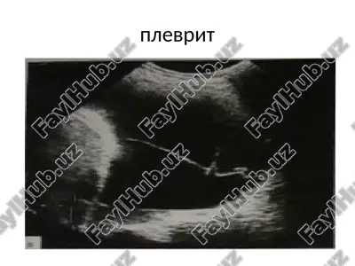plevrit — PPTX