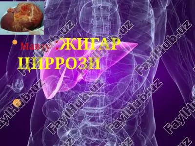 жигарциррози — PPTX