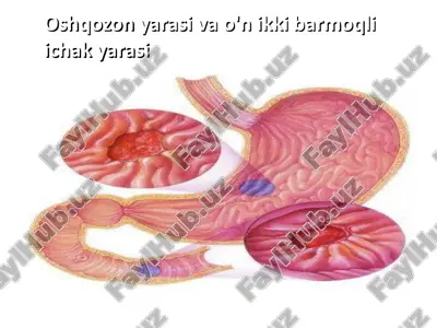 oshqozon yarasi va o'n ikki barmoqli ichak yarasi — PDF
