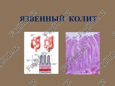 nespetsificheskiy yazvenniy kolit — PPT