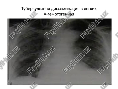 tuberkulez — PPTX