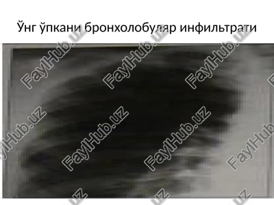 o'ng o'pkani bronxolobulyarinfiltrati — PPTX